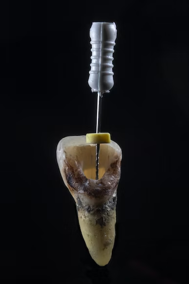 photo of a rotten teeth receiving root canal