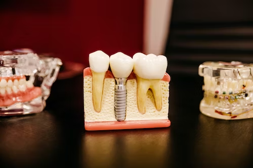 photo of a dental implant between teeth