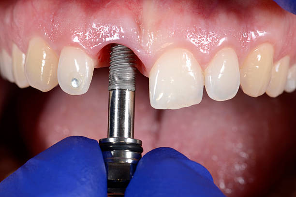 close-up shot of a dental implant 