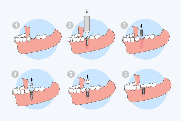 a digital illustration of how dental implants are placed