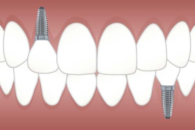 dental implants illustration