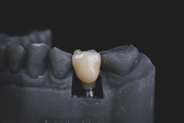 dental implants on a black dental model of the lower jaw