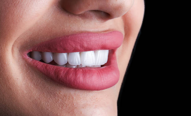 close-up shot of a woman with beautiful veneers