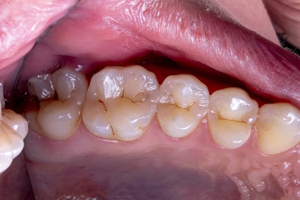 phot showing damaged teeth